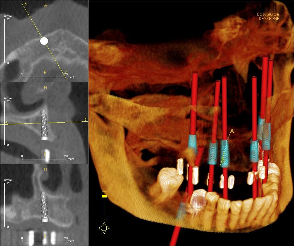 A model of a dental implant fixture and crown