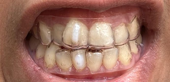 A clear thermoplastic orthodontic retainer